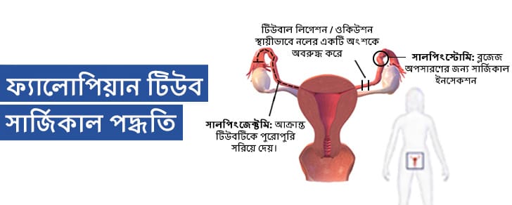 অবরুদ্ধ ফলোপিয়ান টিউব গুলির জন্য টিউবাল লিগেশন রিভার্সাল